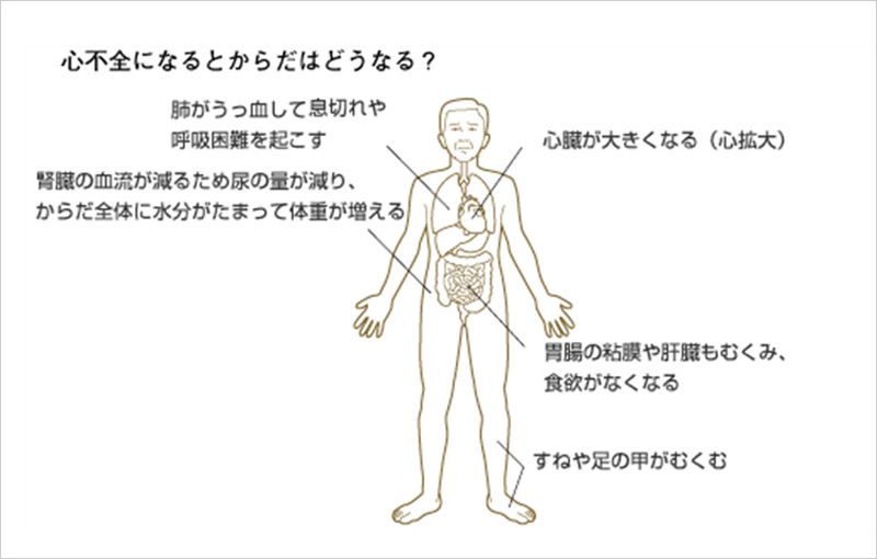 心不全とは 心不全がよくわかる 心不全 Com 日本メドトロニック株式会社