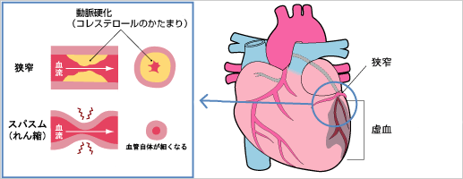 虚血性心疾患（心筋梗塞・狭心症）