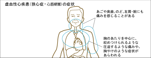 虚血性心疾患（心筋梗塞・狭心症）の症状