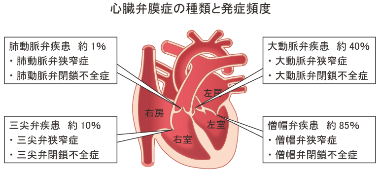 心臓弁膜症の種類と発症頻度