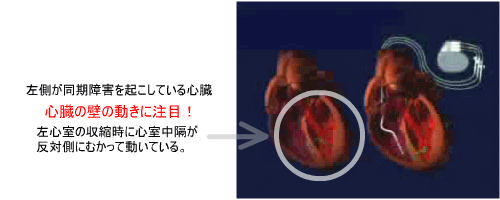 左側が同期障害を起こしている心臓